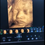 Bạn đã bao giờ thấy em bé mở mắt ngay khi còn trong bụng mẹ chưa???❤️❤️❤️???